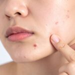 Acne