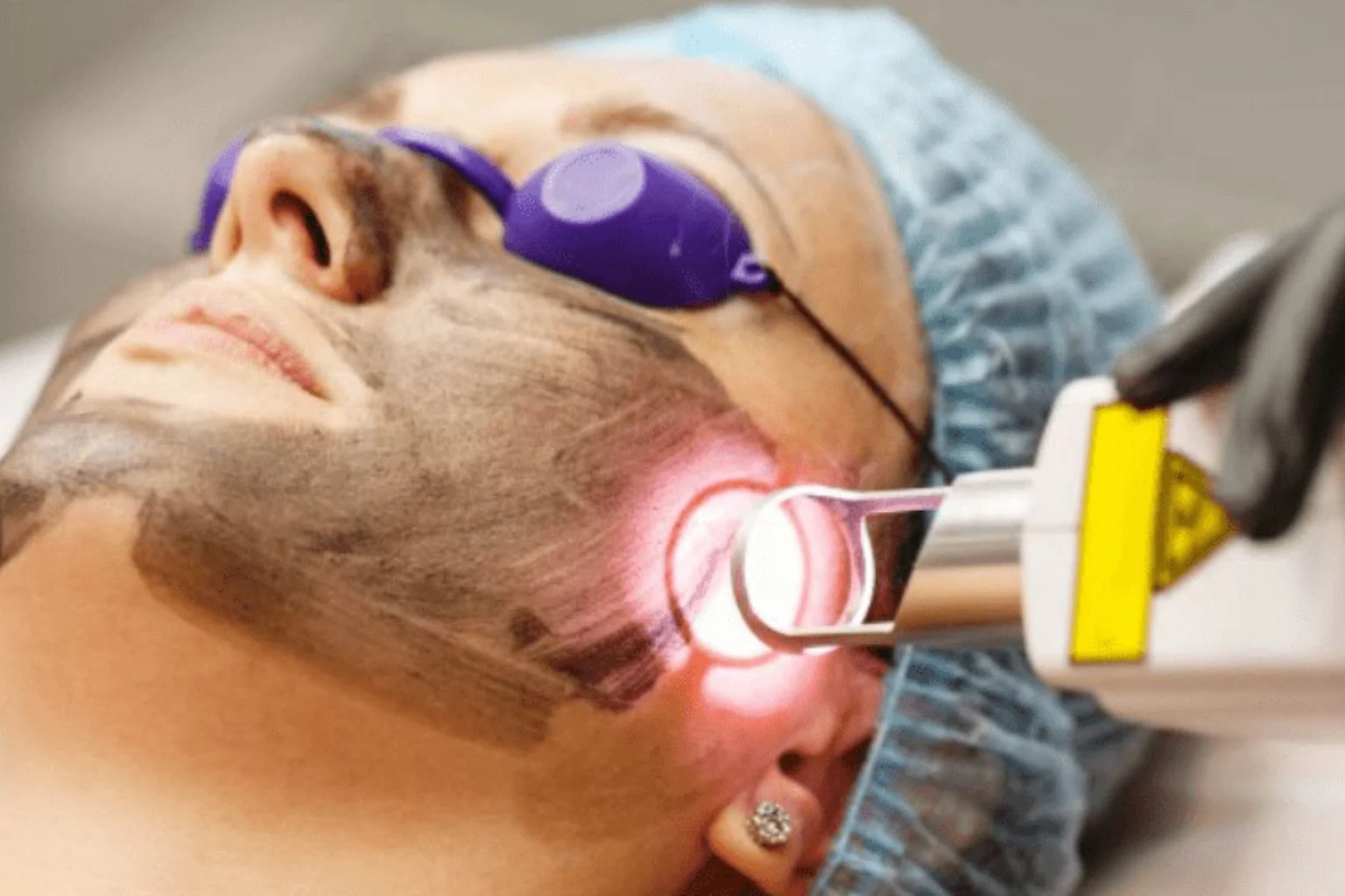 Laser Skin Treatments