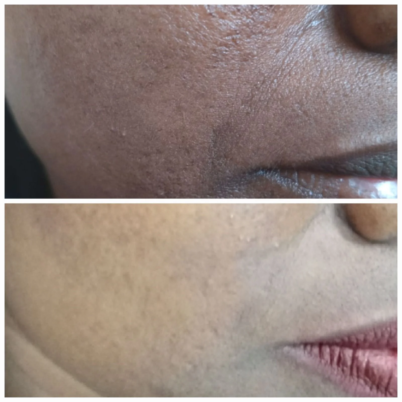 skinstudio-acne-scar-treatment-before-after-closeup