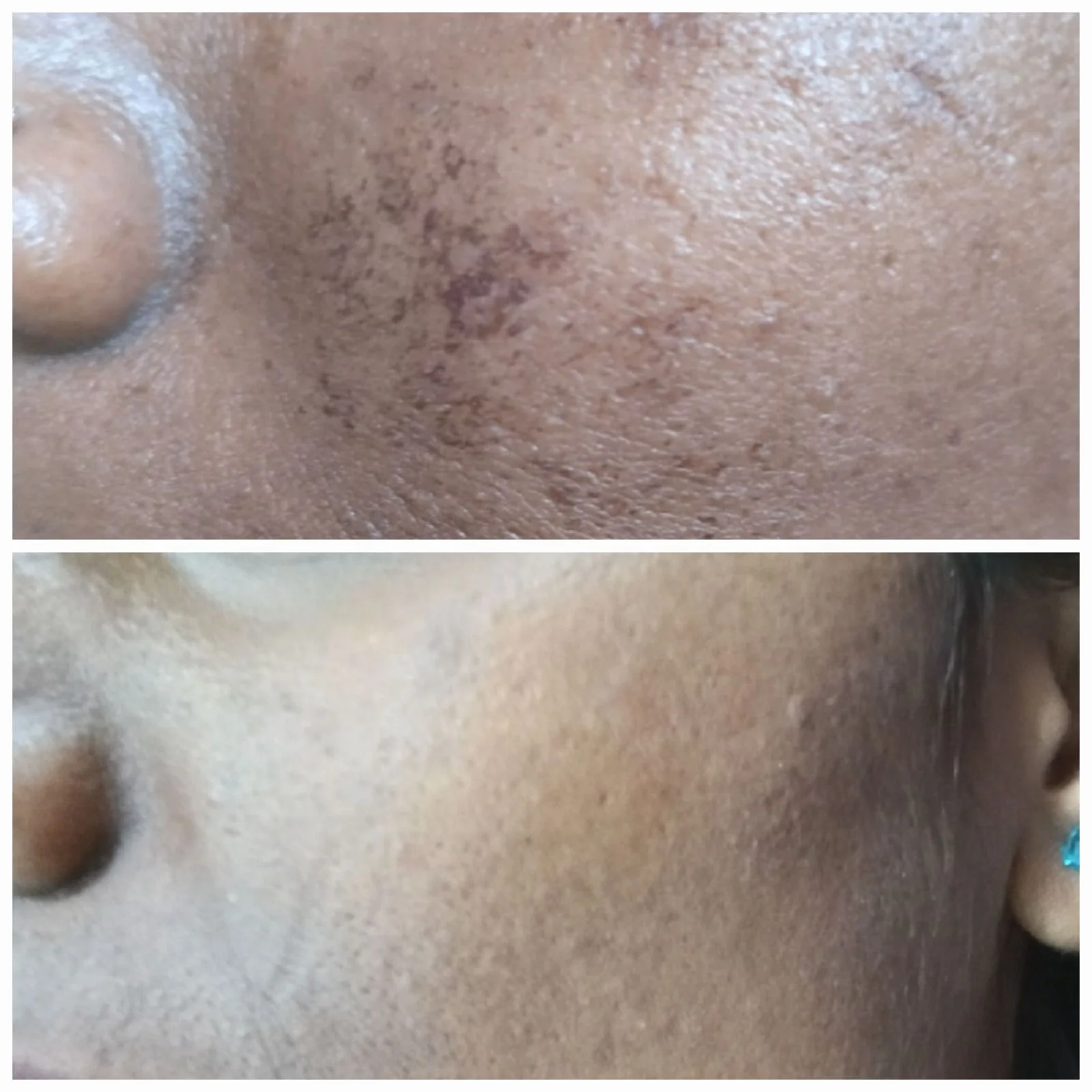 skinstudio-acne-treatment-results