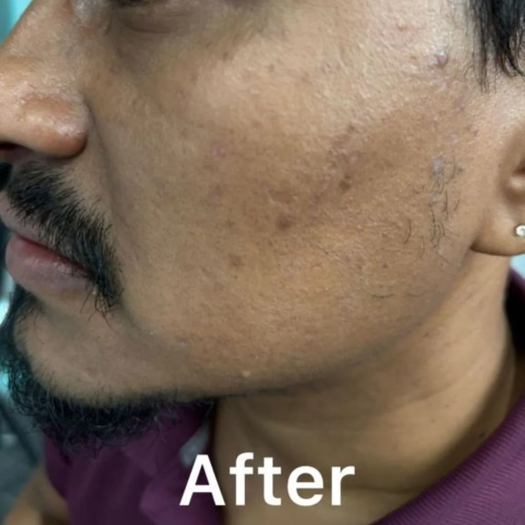 skinstudio-pigmentation-dark-spots-treatment-before-after